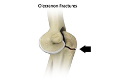 Elbow Fractures