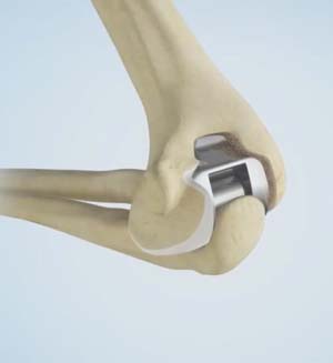 Elbow Joint Replacement