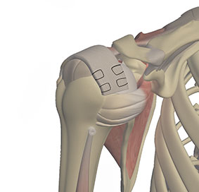 Latissimus Dorsi Tendon Transfer for Rotator Cuff Repair