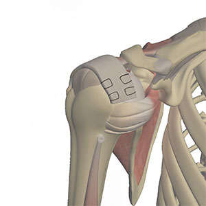 Latissimus Dorsi Tendon Transfer