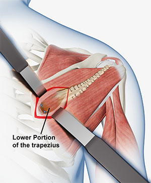 Lower Trapezius Tendon Transfer