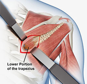 Lower Trapezius Tendon Transfer