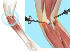 Tennis Elbow Surgery